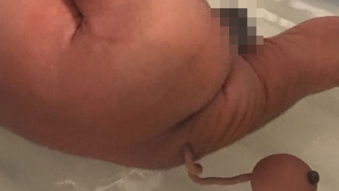 W Brazylii noworodek urodził się z ogonem. 