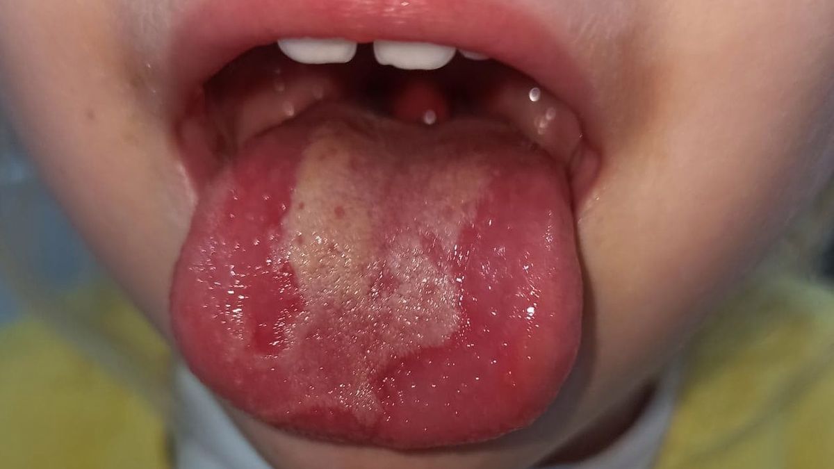 Zakażeni koronawirusem zgłaszają nowe objawy zakażenia, wśród nich m.in. owrzodzenie języka i jamy ustnej