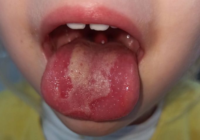 Zakażeni koronawirusem zgłaszają nowe objawy zakażenia, wśród nich m.in. owrzodzenie języka i jamy ustnej