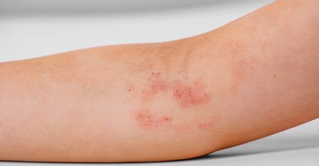 Dermatol – działanie, stosowanie, wskazania i środki ostrożności