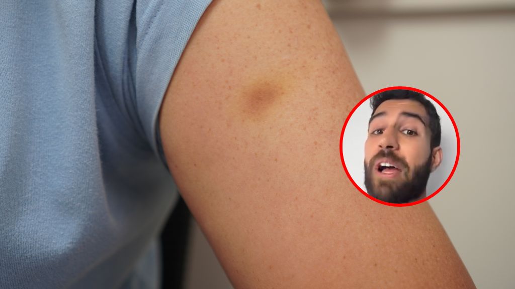 Małe purpurowe lub brązowawe ślady na skórze mogą być sygnałem ukrytych chorób