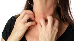 Objaw chłoniaka Hodgkina. Lekarze bagatelizowali dolegliwości