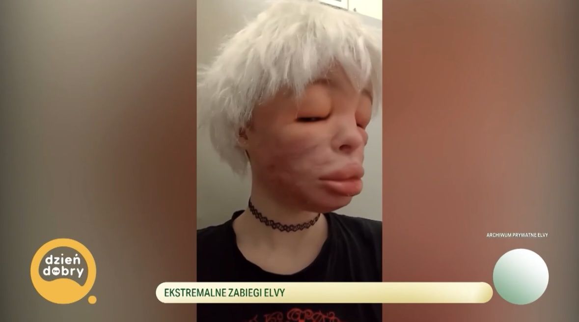 26-letnia Elva zdeformowała sobie twarz