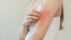 Locoid - skład, działanie, wskazania, przeciwwskazania, skutki uboczne