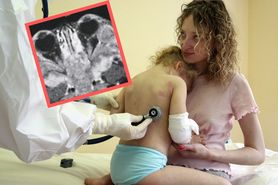 "Oczy szopa". Niewinny objaw groźnego raka