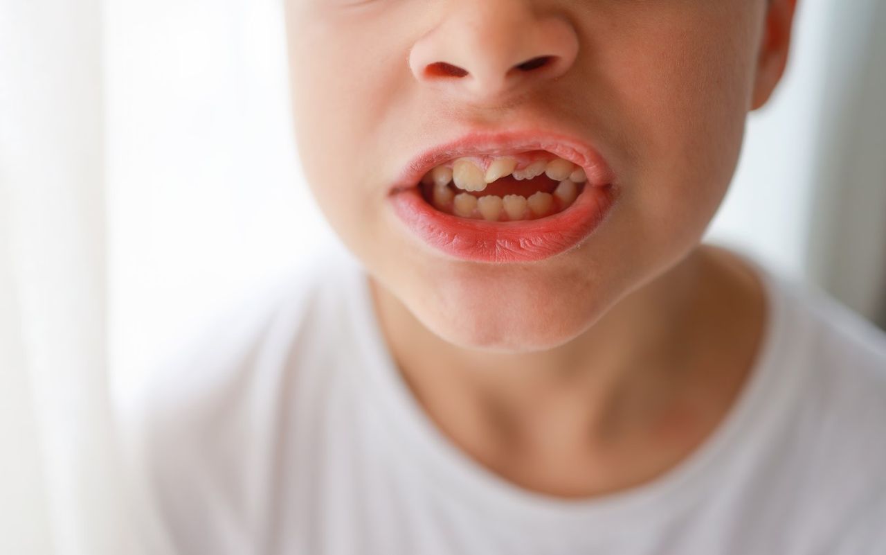 Wada zgryzu – przyczyny, rodzaje i leczenie