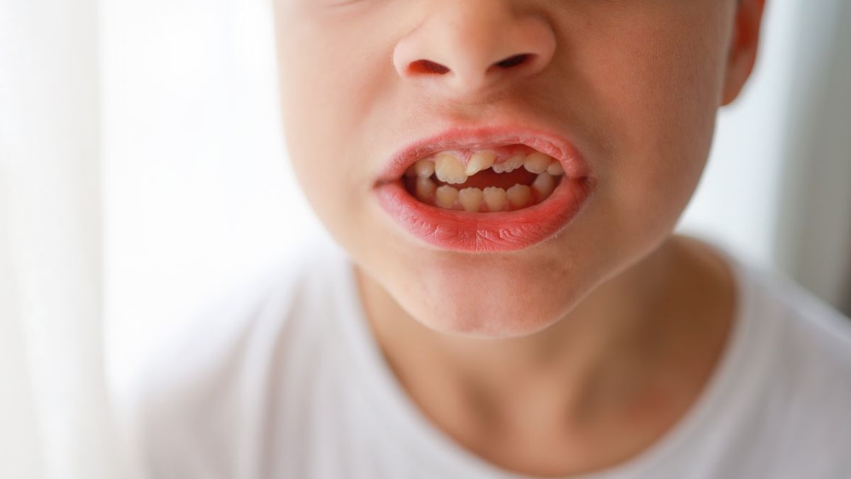 Wada zgryzu to morfologiczno-czynnościowe zaburzenia w obrębie narządu żucia.