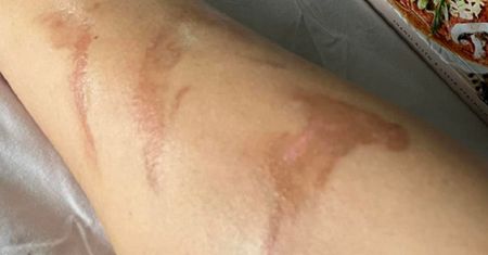 Wróciła z egzotycznych wakacji. Ma przykrą pamiątkę na lata