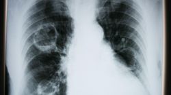 Lekarz wyjaśnia, jak koronawirus niszczy płuca. Zmiany występują nawet u pacjentów, którzy ozdrowieli
