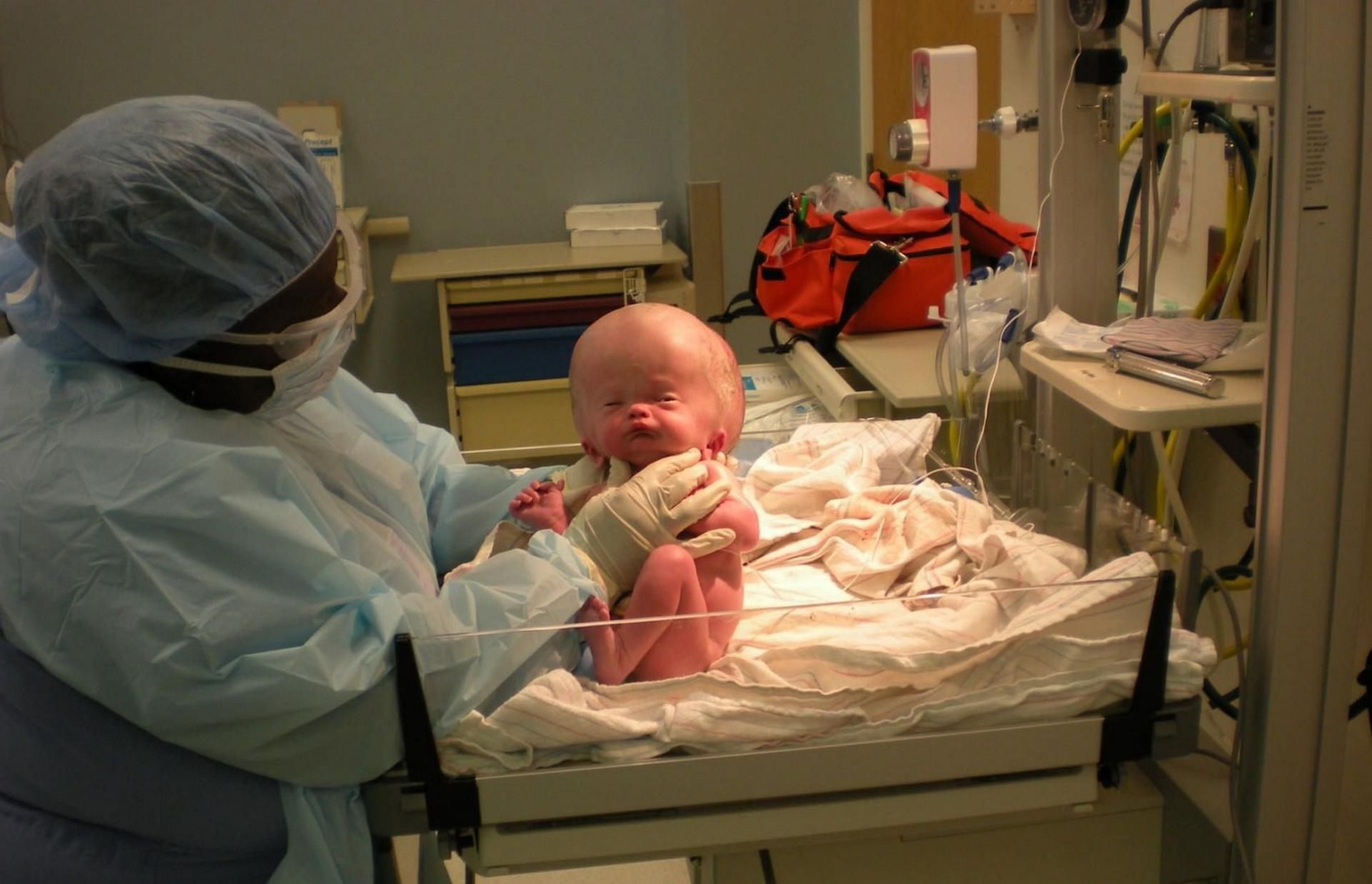 Urodził się z bardzo opuchniętą głową