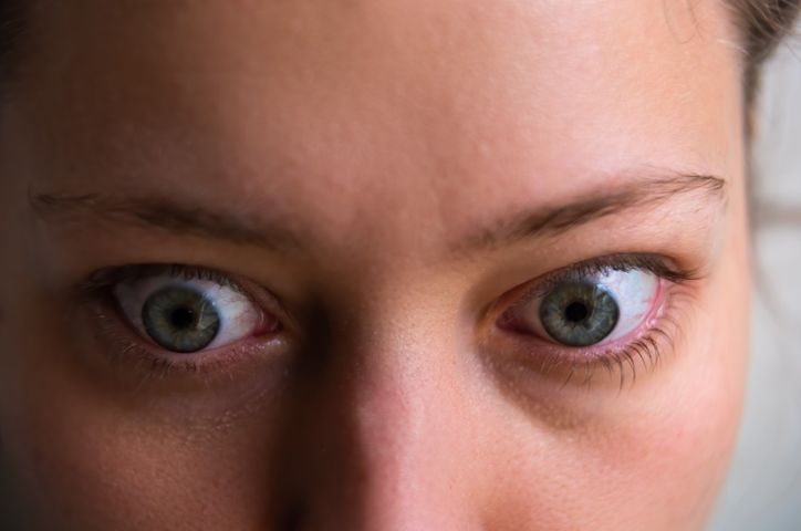 Orbitopatia tarczycowa, czyli wytrzeszcz gałek ocznych, to objaw chorób tarczycy związanych z nadczynnością gruczołu.