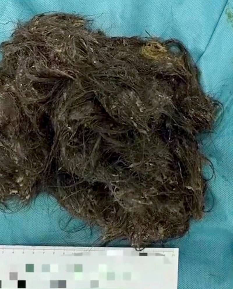 Włosy, które zjadłą 14-latka