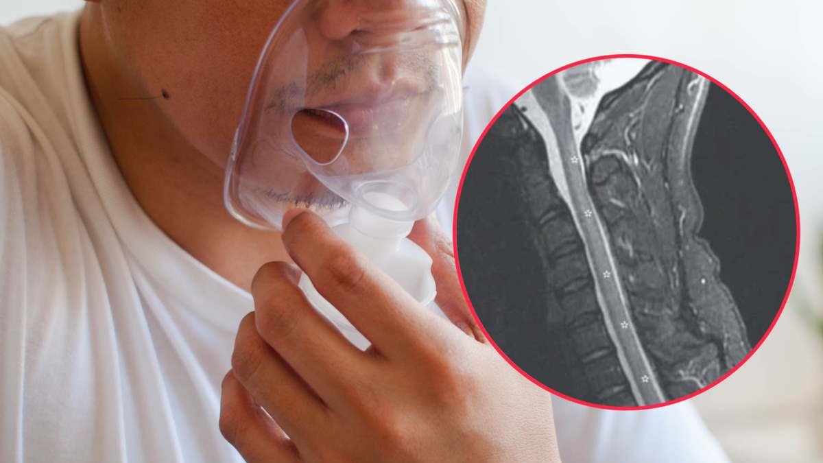 Wdychanie gazu rozweselającego może prowadzić do uszkodzenia nerwów i paraliżu
