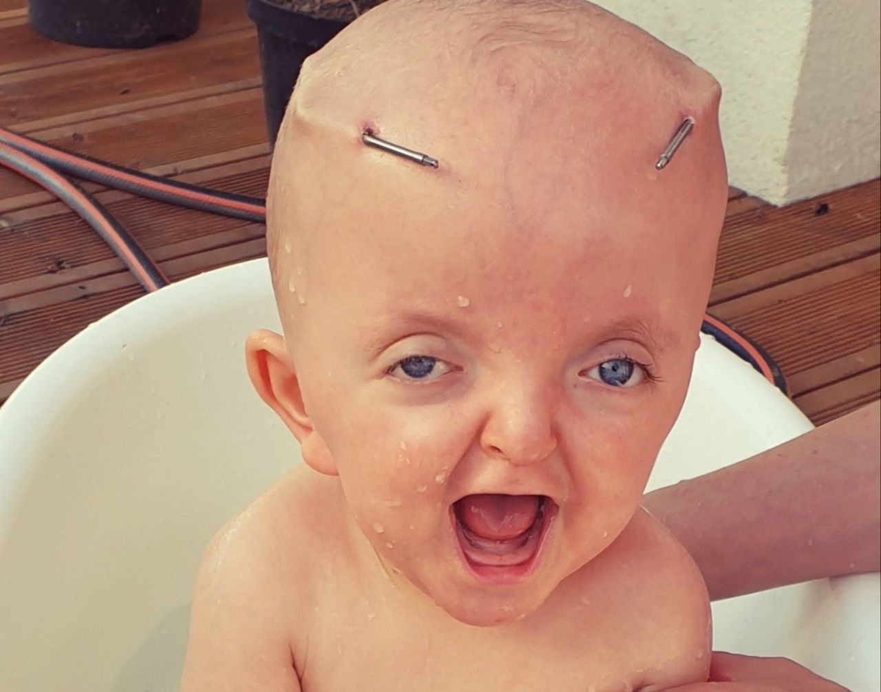 Leoś przeszedł już operację poszerzania czaszki