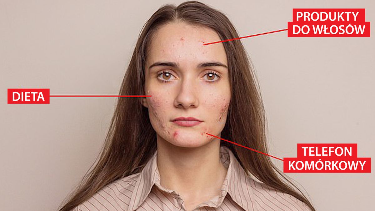 Najczęstsza przyczyna trądziku na twarzy