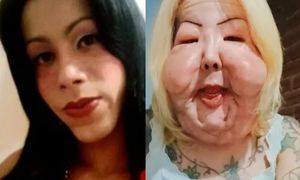 Chciała poprawić urodę. Dziś walczy o odzyskanie dawnej twarzy