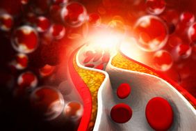 Boisz się, że masz za wysoki cholesterol? Sprawdź, czy znasz ten objaw