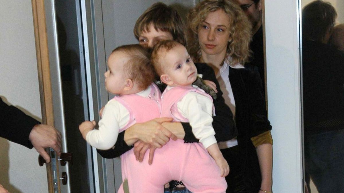 Operacja rozdzielenia zmieniła ich życie