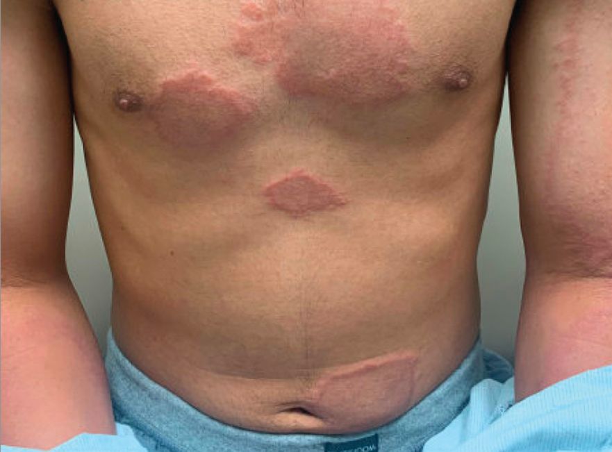 Nikt nie przypuszczał, co może być przyczyną dziwnej wysypki