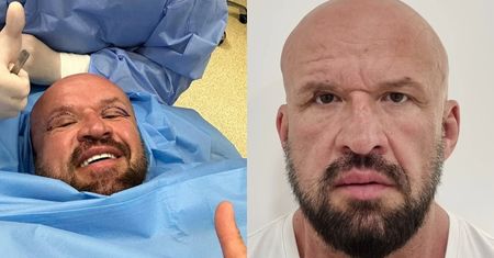 Tomasz Oświeciński też zoperował opadające powieki. "Coraz mniej widziałem"