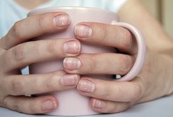 Białe plamy na paznokciach. Co oznaczają i jak się ich pozbyć?