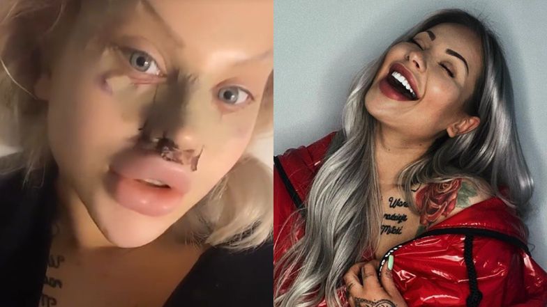 Ewel0na z "Warsaw Shore" zoperowała nos w Turcji 