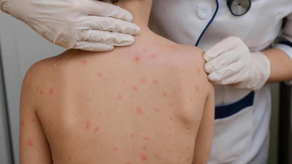 Tak rozpoznasz wysypkę u dziecka