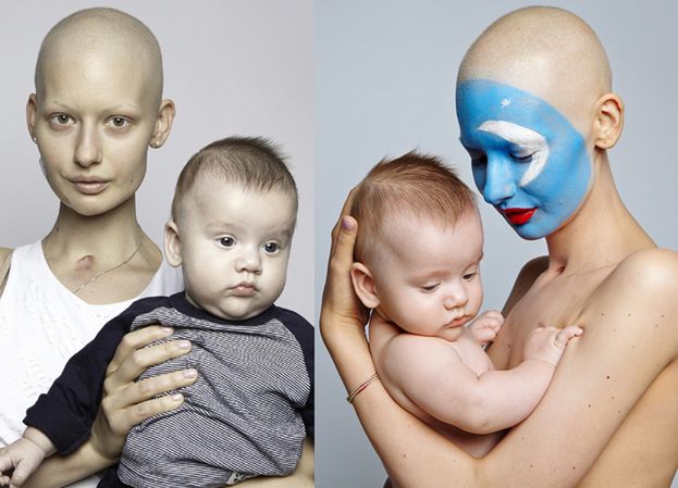 24-letnia modelka zachorowała na raka w ciąży. Straciła 95% szczęki