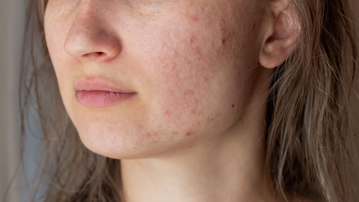 Higiena przy trądziku jest kluczowa 