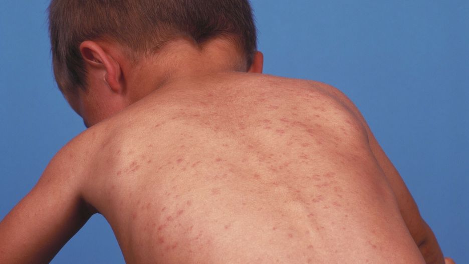Stock pictures
PHOTO: EAST NEWS/SCIENCE PHOTO LIBRARY 
Measles rash on a child's back. Measles is a highly infectious viral disease spread through the air. Also called morbilli or rubeola, it mainly affects children, but can occur at any age. The adult form is more severe. An attack usually gives lifelong immunity. After an incubation period (8- 15 days), flu-like symptoms develop, accompanied by fever. Four days later, a red rash appears that lasts 3-5 days. Complications include ear and chest infections, diarrhoea and vomiting. Recovery takes 2-4 weeks. Treatment includes drinking lots of fluids and rest. Vaccination against measles provides effective immunity..
ALEX BARTEL