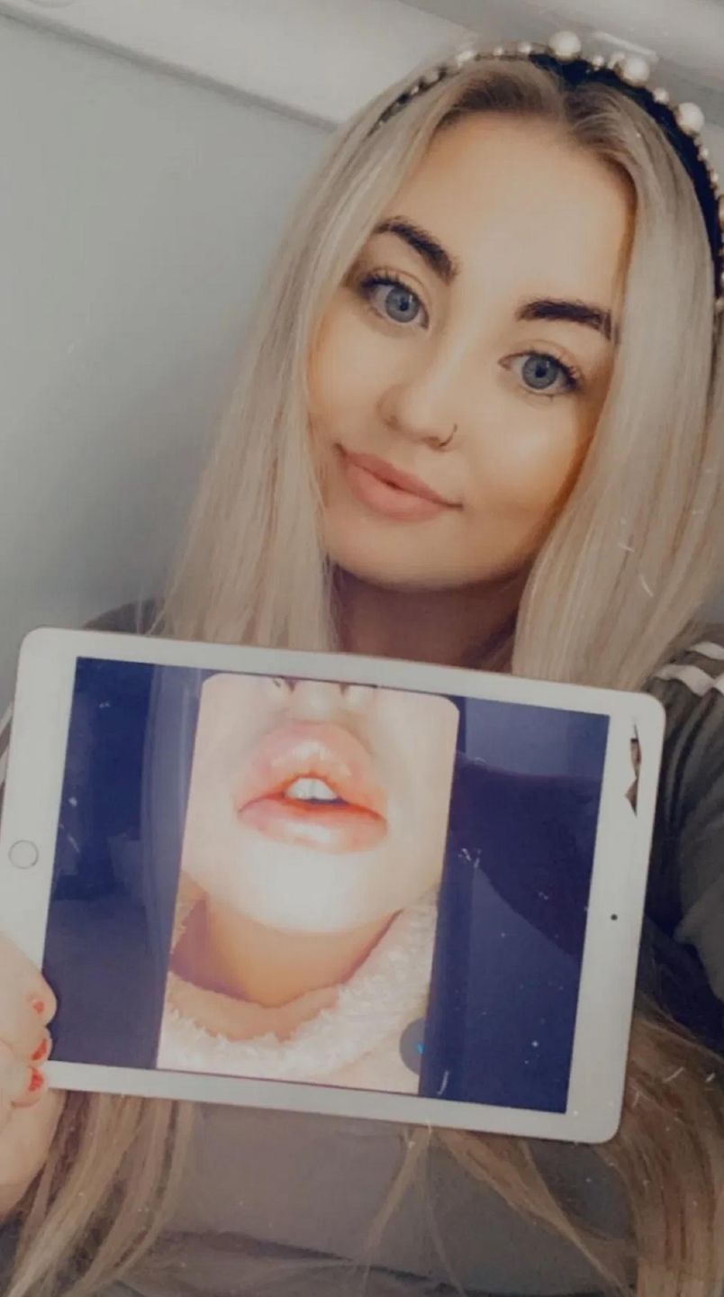 Mama opowiada o swoim traumatycznym doświadczeniu z botoksem