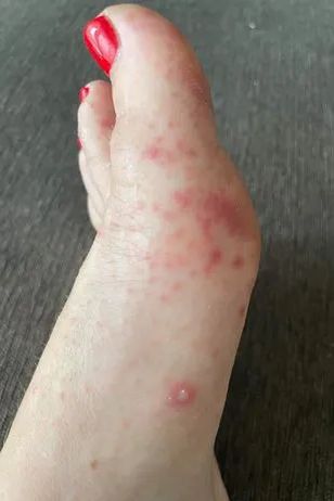 Bolesne rany goiły się z trudem