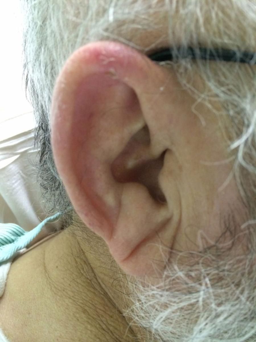 Znak Franka to niewielka bruzda na płatku ucha