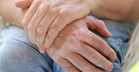 Białe plamy na skórze - produkcja melaniny, opalanie, bielactwo, grzybica skóry