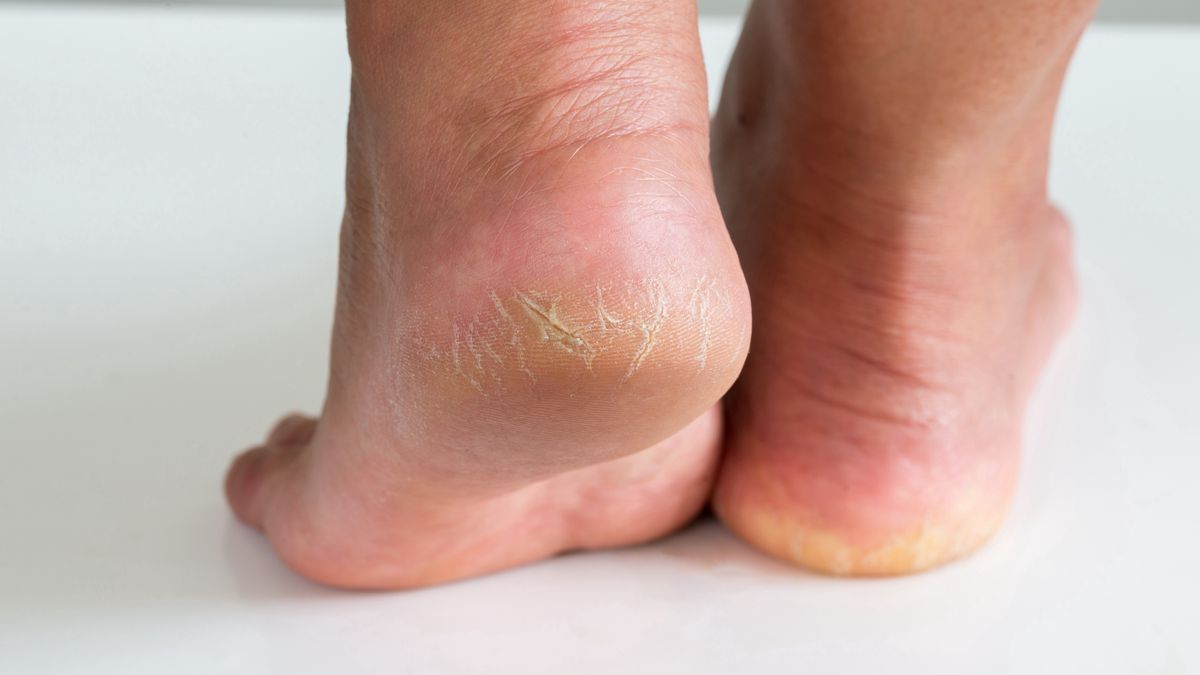 Co pomaga na suche pięty?