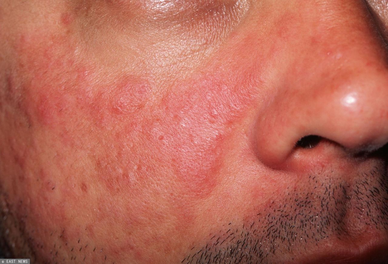 Pierwszy objaw może pojawić się na nosie. Choroba uszkadza nerki, stawy czy mózg