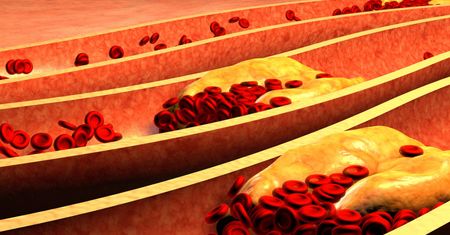 Wysoki poziom cholesterolu powoduje zmiany w organizmie. Zobacz jakie (WIDEO)