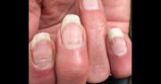 Covidowe paznokcie. Coraz częstszy objaw u zakażonych koronawirusem