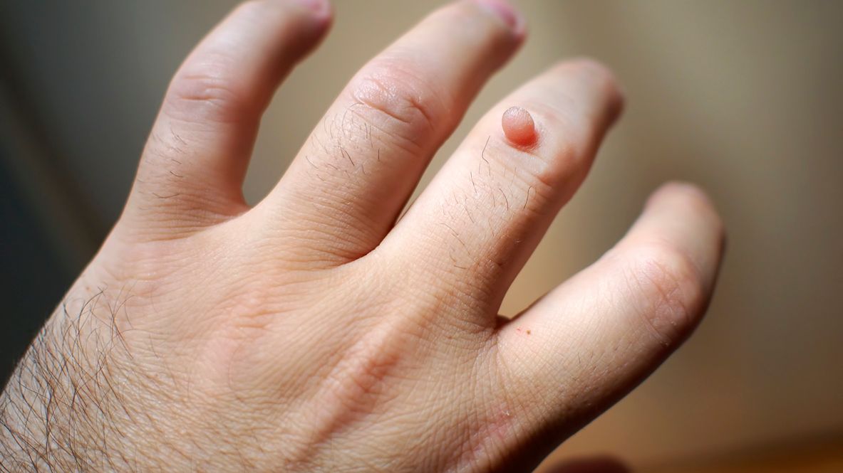 Kurzajki są wywoływane przez różne typy wirusa brodawczaka ludzkiego (HPV).