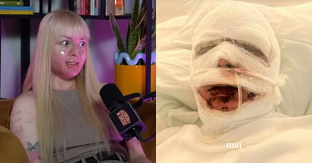 Tiktokerka płonęła żywcem na imprezie. Dziś wspomina: "Kiedy się obudziłam, ból był nie do opisania. Lekarze podawali nam FENTANYL"