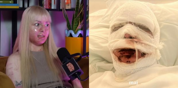 Tiktokerka płonęła żywcem na imprezie. Dziś wspomina: "Kiedy się obudziłam, ból był nie do opisania. Lekarze podawali nam FENTANYL"
