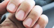 Prążki na paznokciach. Zobacz o czym świadczą