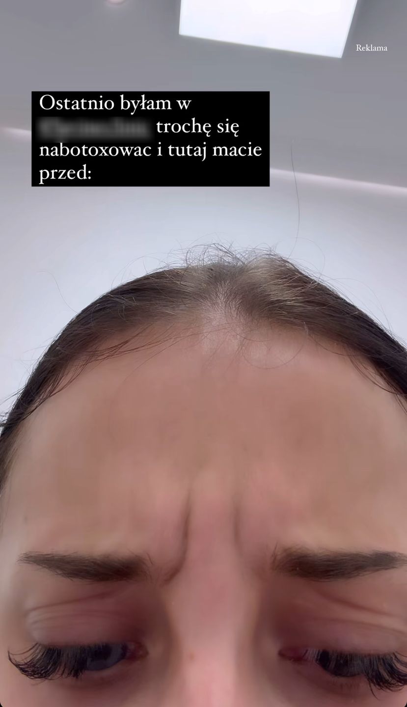 Fagata pochwaliła się botoksem