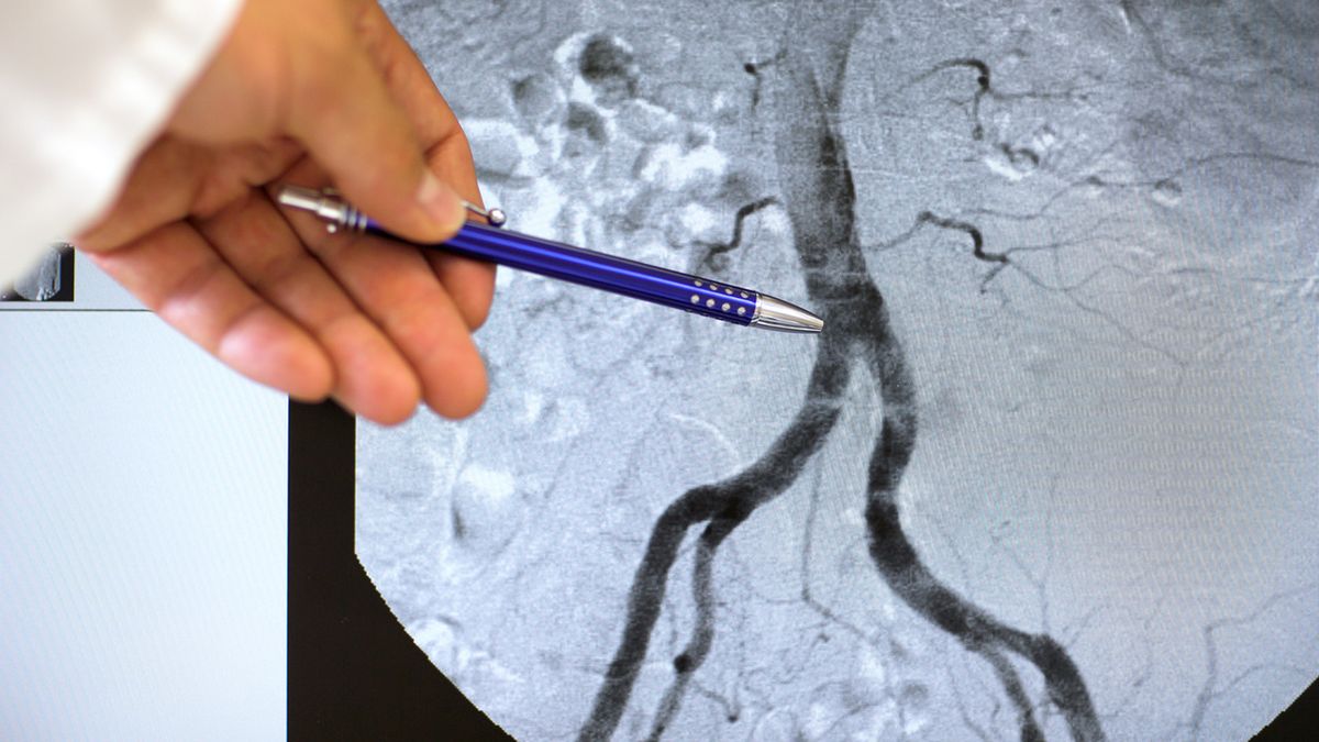 Choroby aorty mogą być wrodzone lub nabyte.