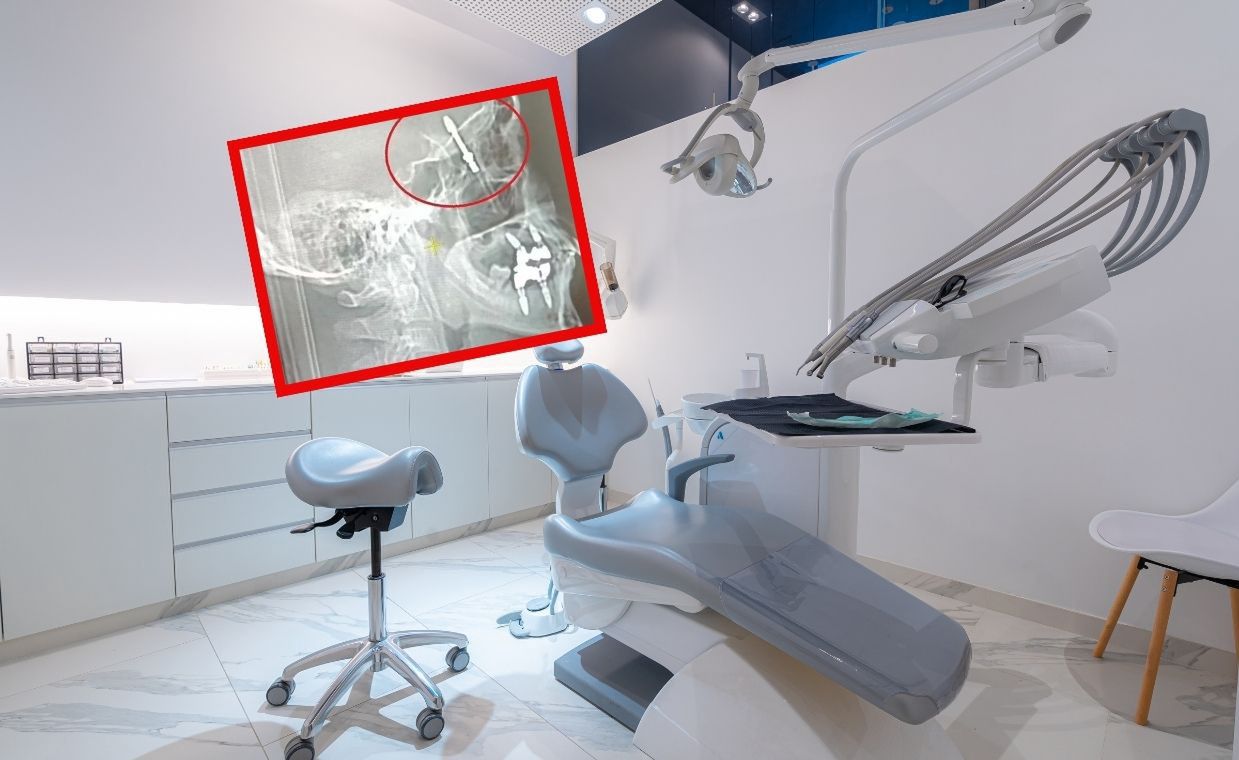 Dental implant mishap in Turkey: Surgeon's error pierces patient's brain