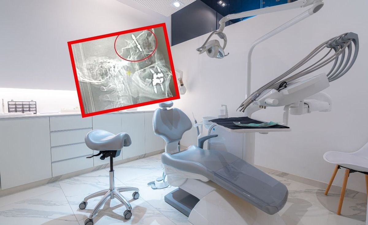 Dentysta wszczepił implant do mózgu pacjenta