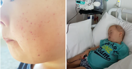 Pierwszym objawem była wysypka. "Lekarz pobladł"