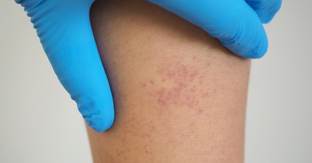 Małopłytkowość w ciąży – przyczyny, objawy i postępowanie