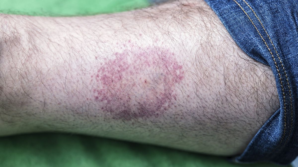 Circular Bulls Eye Tick Bite Skin Rash
The distinctive, almost unmistakable sign of a tick bite is reflected in this tell-tale, mottled, circular, bulls eye-shaped skin rash with a tiny scab in the center on a young man's hairy lower leg. He'd been out camping - often walking in tall rural grass - wearing cargo shorts the last few days. He will be okay after testing negative for Lyme Disease.
Willowpix
scab, tell-tale, indicator, indication, rash, ring, distinctive, unmistakable