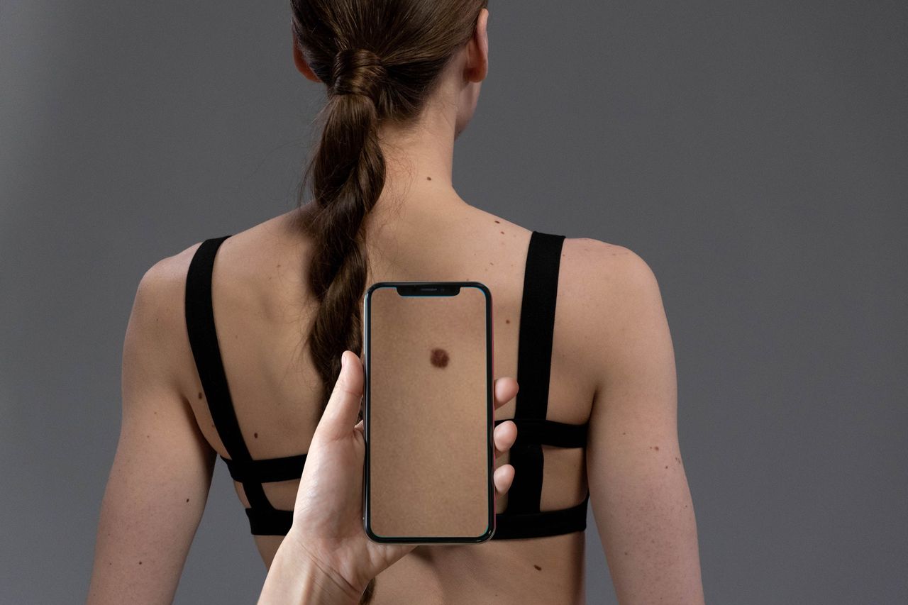 Wystarczy smartfon, by wykryć raka skóry. To rozwiązanie jest prawdziwym przełomem